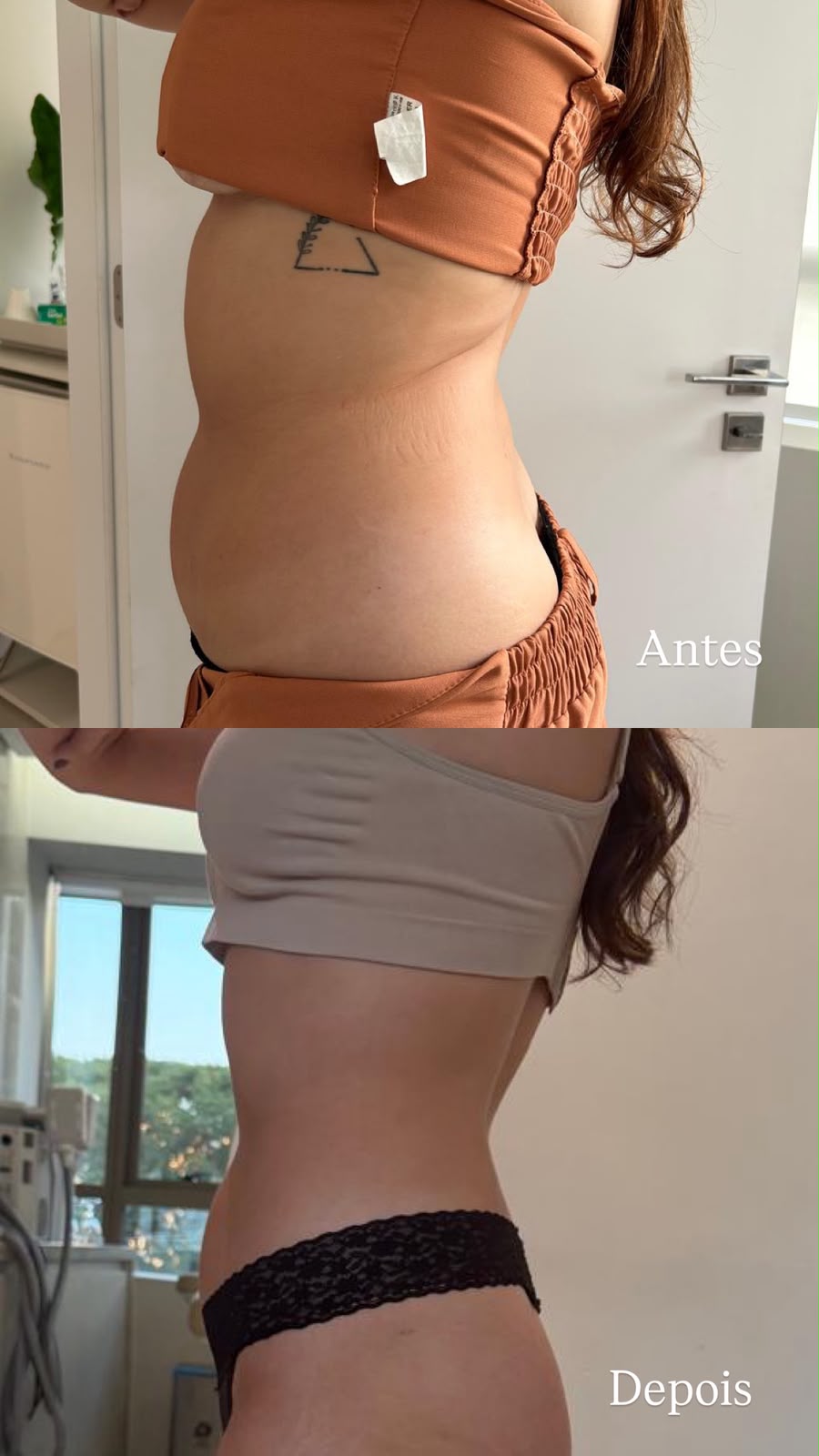 Comparação de antes e depois de acompanhamento nutrológico, perfil lateral