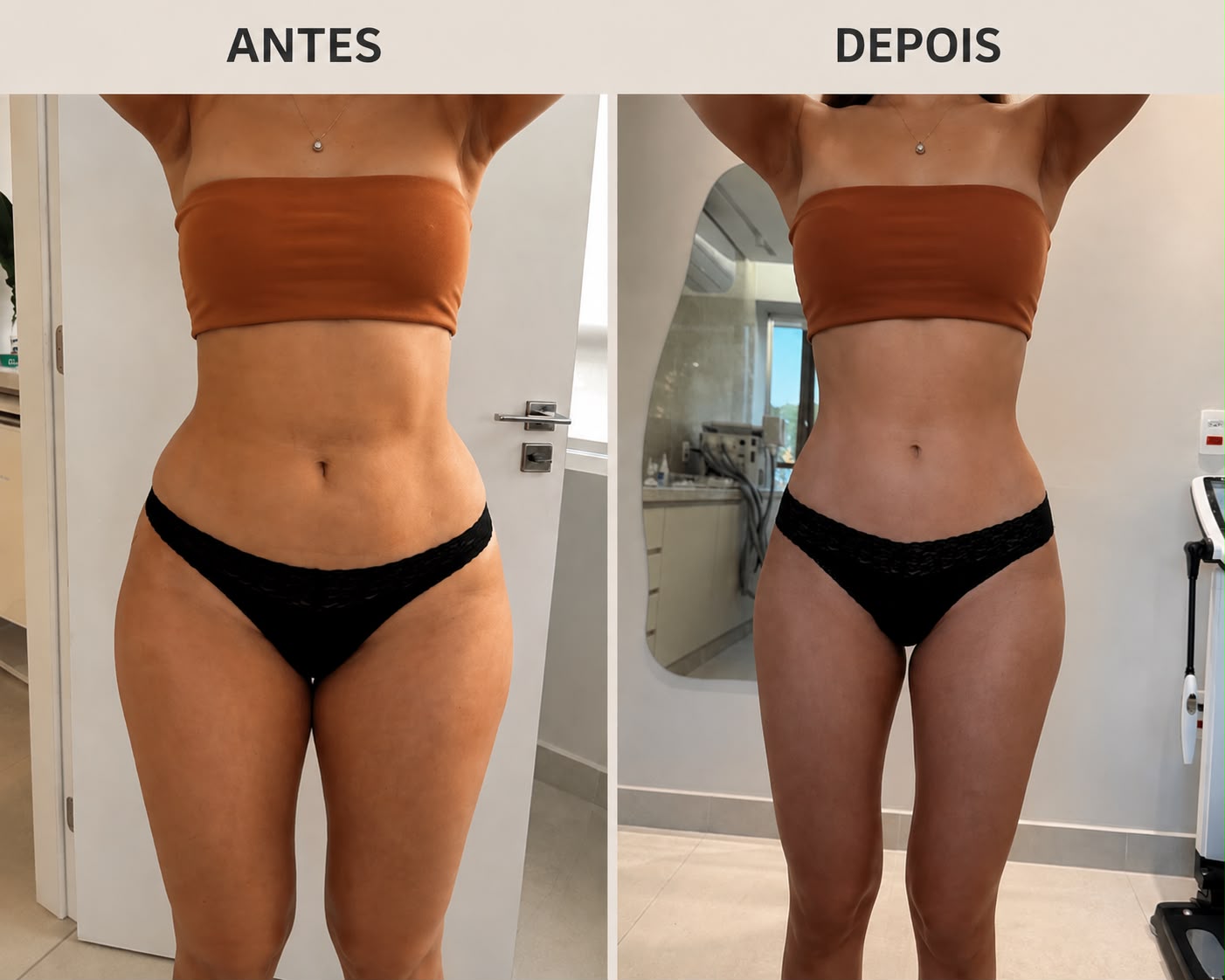 Comparação de antes e depois de acompanhamento nutrológico, vista frontal