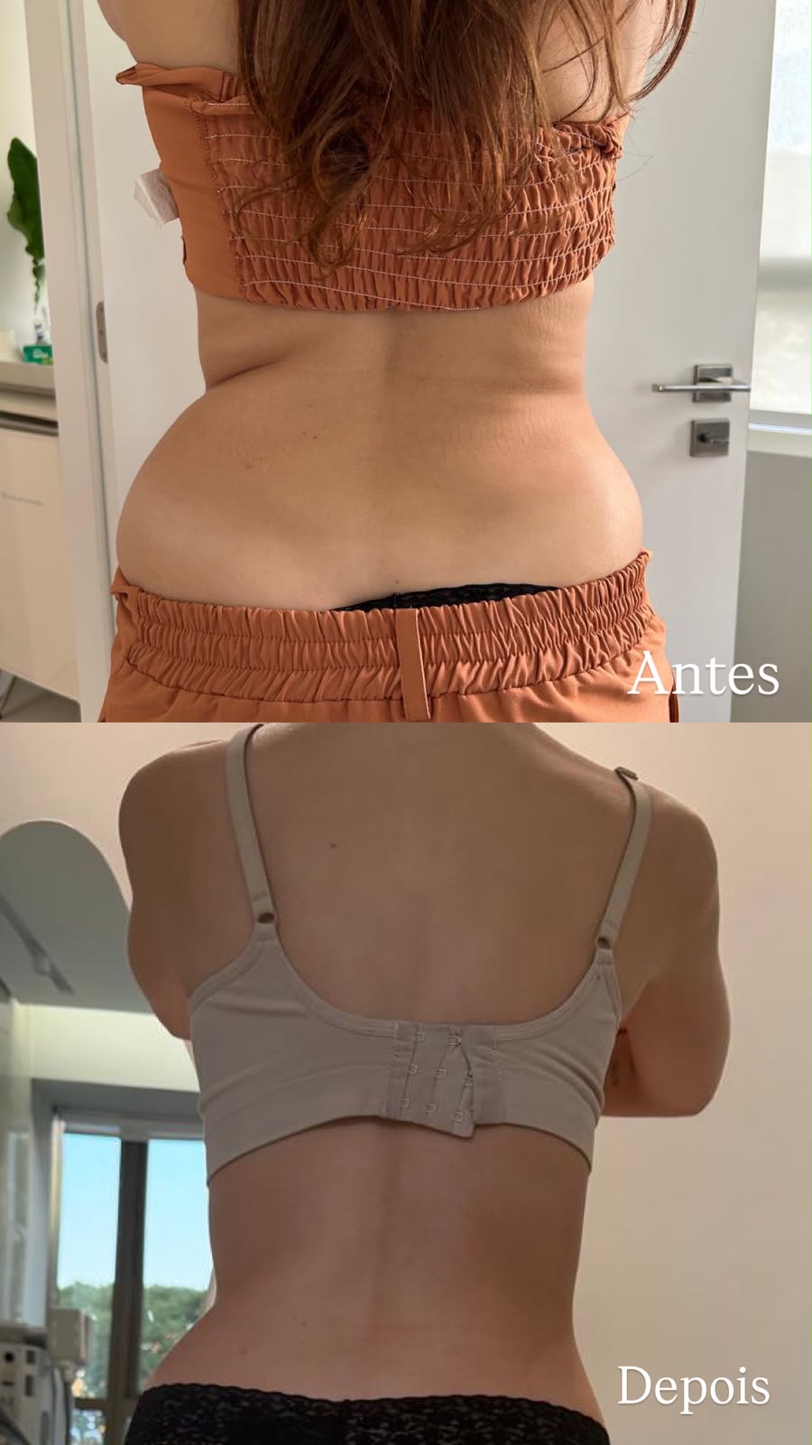 Comparação de antes e depois de acompanhamento nutrológico, vista posterior